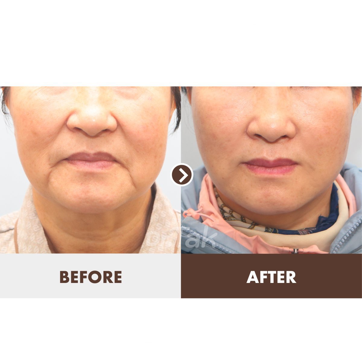 Facelift Vorher-Nachher-Ergebnisse bei Dr. Tak Plastic Surgery, sichtbare Verjüngung