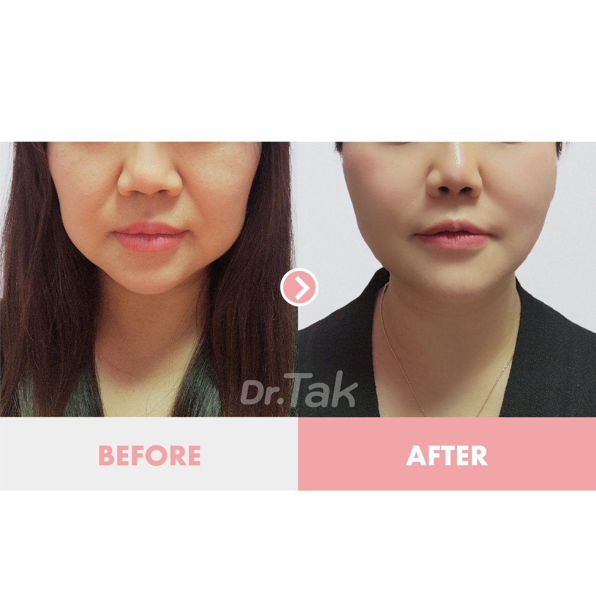 Facelift Vorher-Nachher-Ergebnisse bei Dr. Tak Plastic Surgery, verbesserte Gesichtskontur