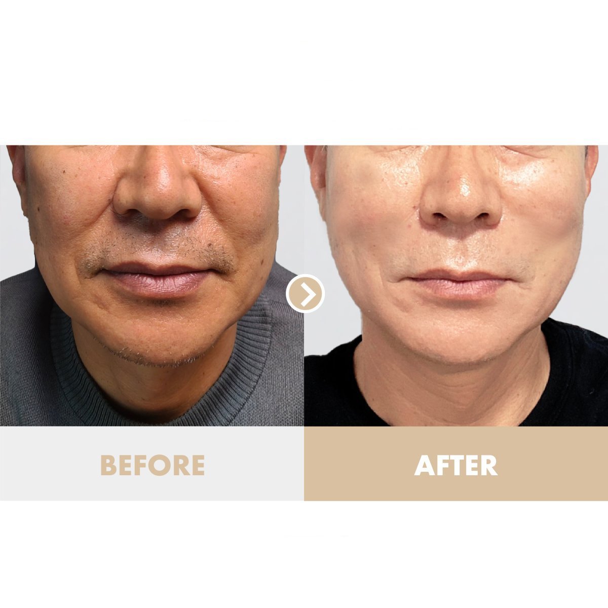 Facelift Vorher-Nachher-Ergebnisse bei Dr. Tak Plastic Surgery, sichtbare Verjüngung