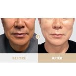 Résultats avant et après lifting chez Dr. Tak Plastic Surgery, rajeunissement visible