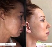 Before and after Deep Plane Facelift results at Dr. Safa Manav Clinic, facial rejuvenation