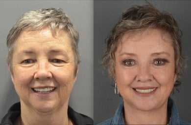 Before and after deep plane facelift results at Dr. Safa Manav Clinic, facial rejuvenation