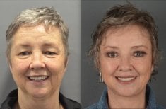 Before and after deep plane facelift results at Dr. Safa Manav Clinic, facial rejuvenation