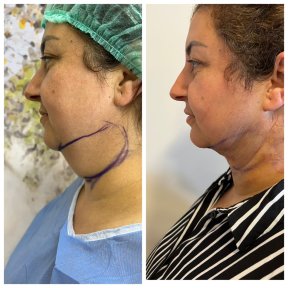 Before and after threads lifting at CE International Hospital, visible neck and jawline lift result