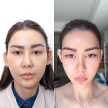Before and after Fox Eye Lift results at Wansiri Hospital, enhanced lifted eye appearance