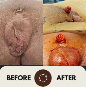 Before and after sex reassignment surgery results at Uroaesthetic, visible genital transformation