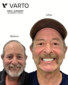 Résultat avant-après implants All-on-4 chez Varto Oral Surgery, sourire amélioré