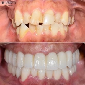 Résultat avant/après implants All-on-4 chez Varto Oral Surgery, sourire amélioré