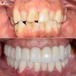 Résultat avant/après implants All-on-4 chez Varto Oral Surgery, sourire amélioré