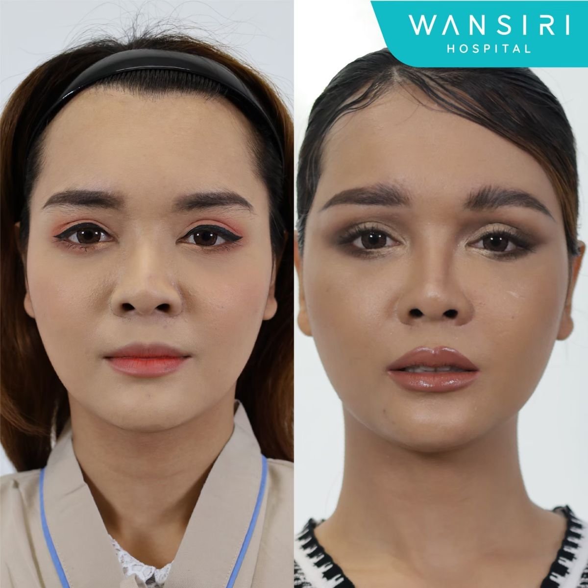 Resultados de lifting de cejas antes y después en Wansiri Hospital, cejas realzadas