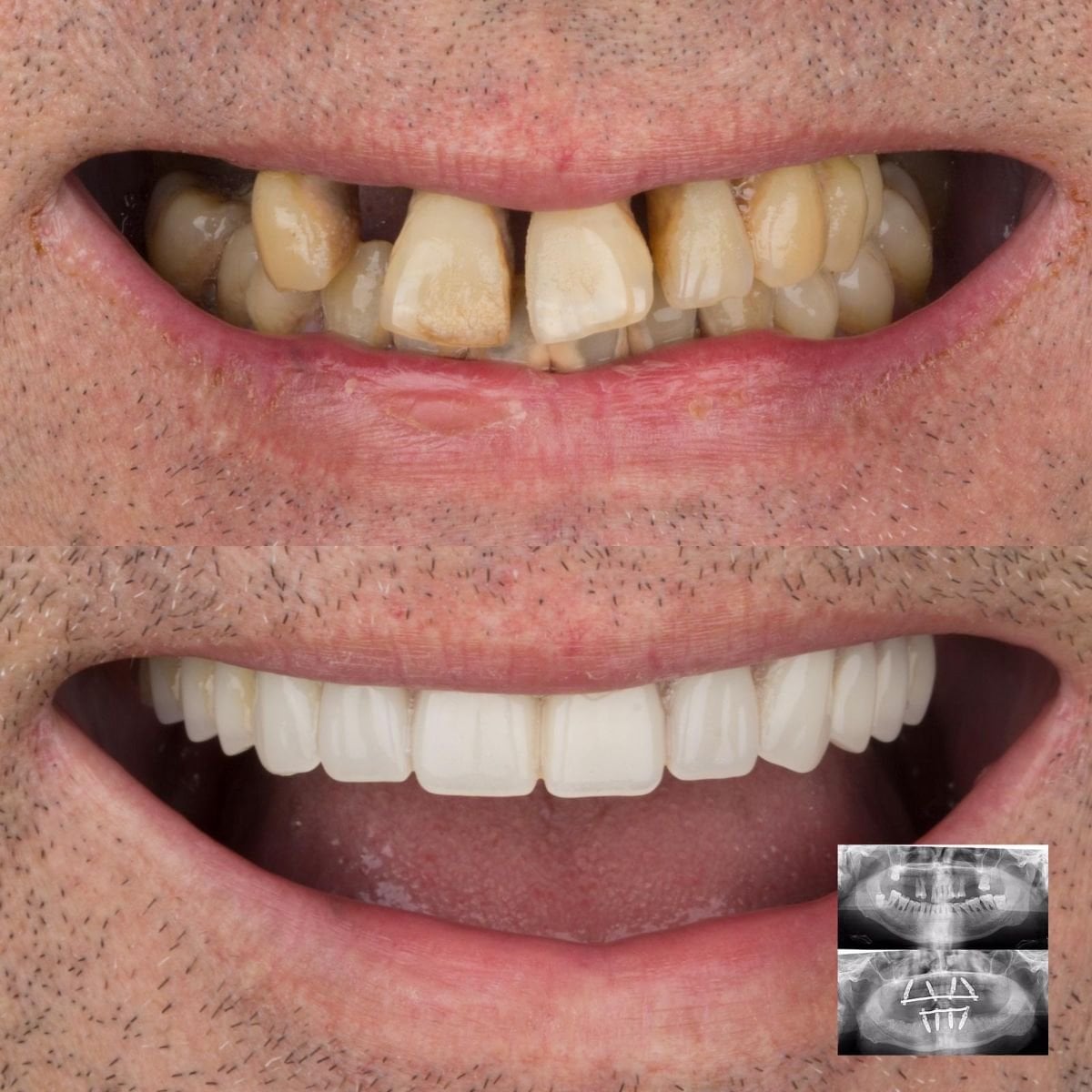 Resultado de implantes dentales All-on-4 antes y después en DENTAGLOBAL Dental Clinic