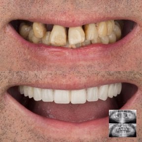 All-on-4 Zahnimplantate Vorher-Nachher-Ergebnis bei DENTAGLOBAL Dental Clinic, neues Lächeln