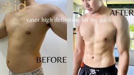 Before and after Vaser liposuction for six pack at ID Clinic Bangkok, defined abs result