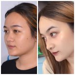 قبل وبعد عملية تجميل الأنف في عيادة Janasia، نتائج طبيعية لتعديل الأنف