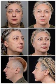 Facelift before and after results at Yurchenko Plastic Surgery Team, visible facial rejuvenation