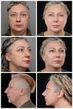 Facelift before and after results at Yurchenko Plastic Surgery Team, visible facial rejuvenation