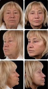 Résultats lifting visage avant/après chez Yurchenko Plastic Surgery Team, rajeunissement visible