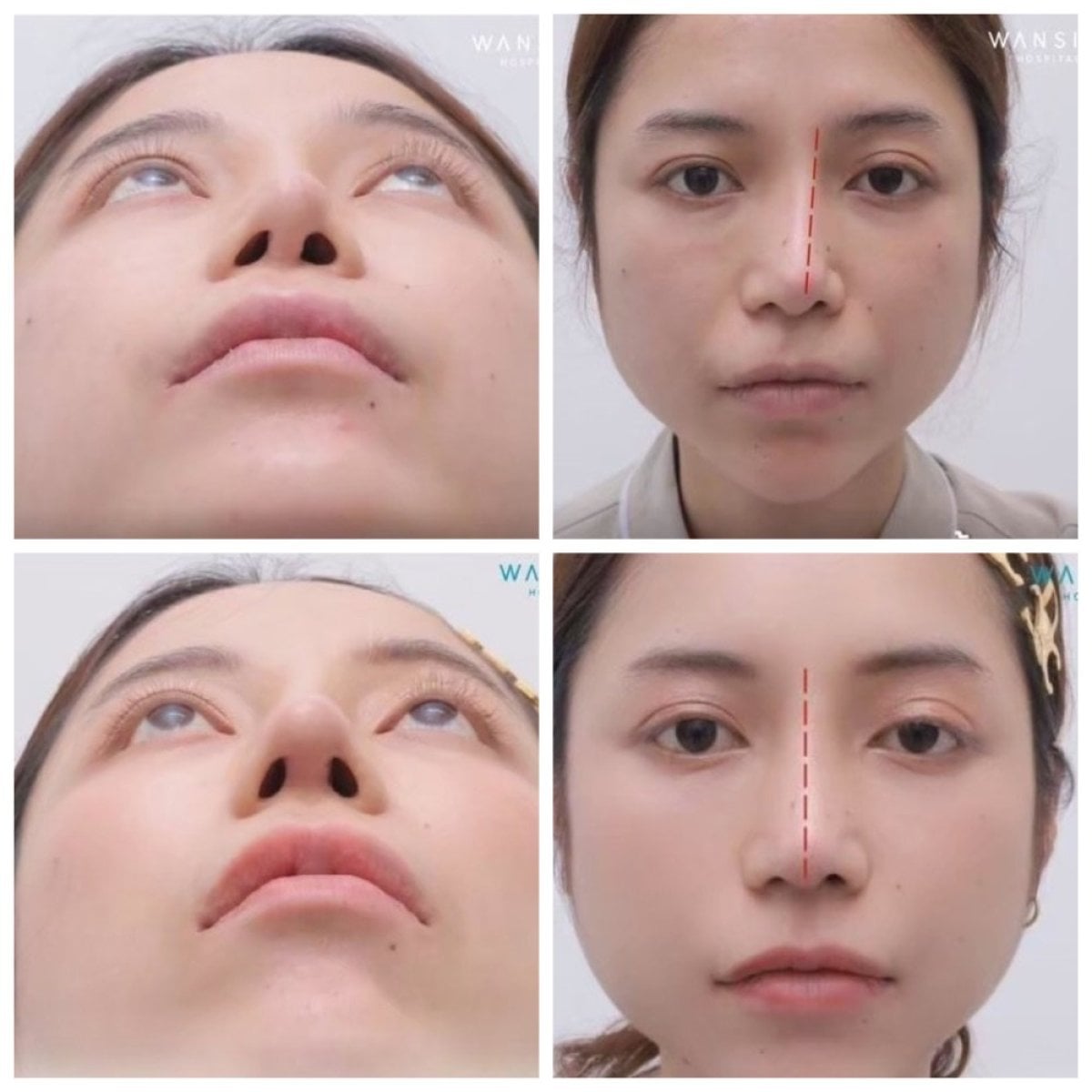 Resultados de septoplastia antes y después en Wansiri Hospital, alineación nasal mejorada