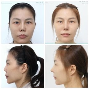Before and after septoplasty results at Wansiri Hospital, improved nasal symmetry and breathing