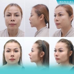 Before and after septoplasty results at Wansiri Hospital, improved nose shape and breathing