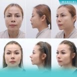 Before and after septoplasty results at Wansiri Hospital, improved nose shape and breathing