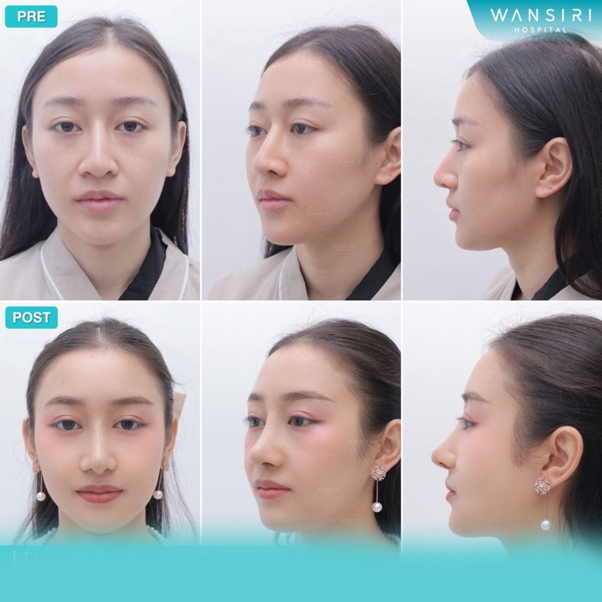 Resultados antes y después de septoplastia en Wansiri Hospital, mejor simetría nasal