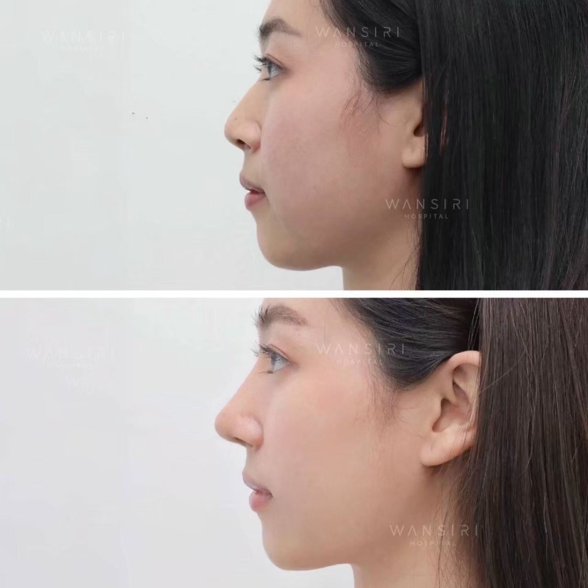 Resultados de septoplastia antes y después en Wansiri Hospital, perfil nasal mejorado