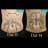 Before and after love handles liposuction results at Wansiri Hospital, visible contour change
