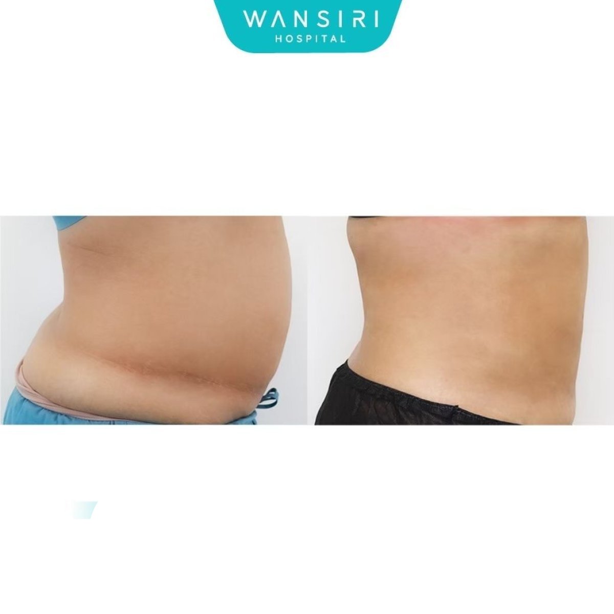 Resultados de liposucción de flancos antes y después en Wansiri Hospital, cintura mejorada