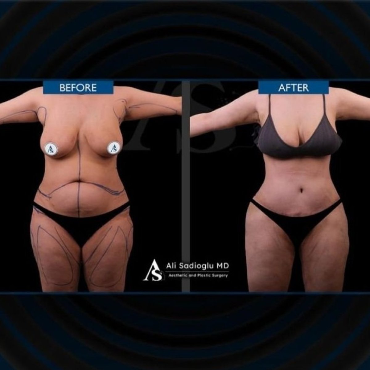 Before and after arm lift (brachioplasty) results at Dr. Safa Manav Clinic, improved arm contour