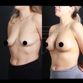 Before and after breast lift results at Dr. Safa Manav Clinic, improved breast contour