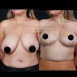 Before and after breast lift results at Dr. Safa Manav Clinic, visible breast contour improvement