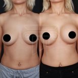Результати до і після підтяжки грудей у клініці Dr. Safa Manav, покращений контур грудей