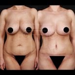 Résultats avant/après lifting mammaire à la clinique Dr. Safa Manav, amélioration visible