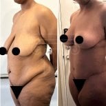 Résultats avant/après lifting mammaire à la clinique Dr. Safa Manav, contour amélioré