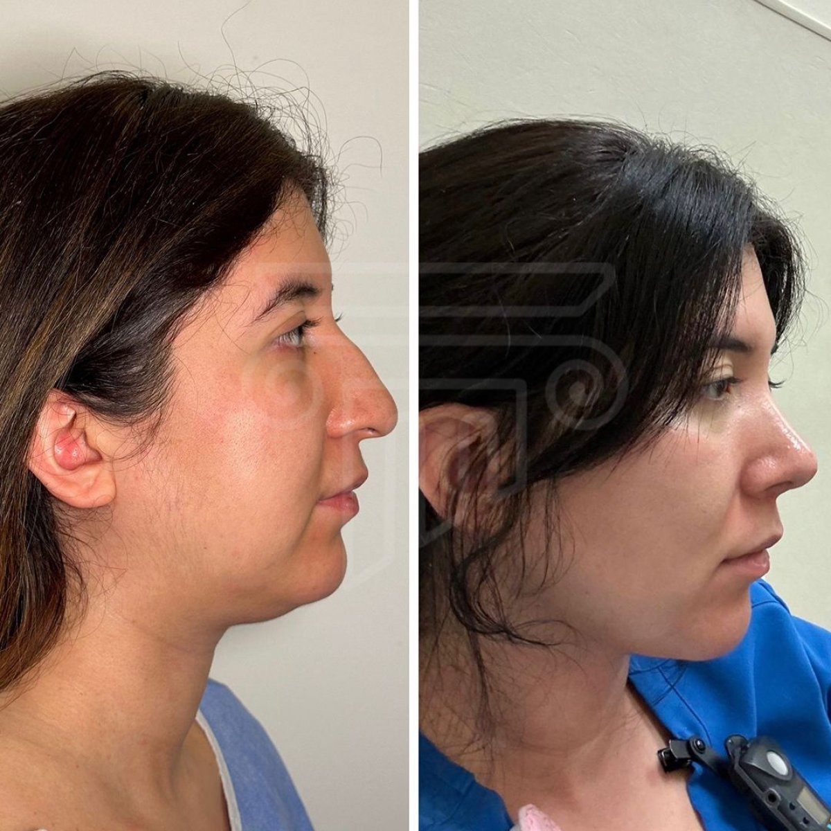 Resultados de liposucción de mentón antes y después en Dr. Safa Manav Clinic, contorno mejorado