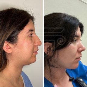 Before and after chin liposuction results at Dr. Safa Manav Clinic, improved jawline contour