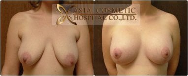 Before and after mommy makeover results at Asia Cosmetic Hospital, breast lift and contouring