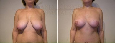 Before and after mommy makeover results at Asia Cosmetic Hospital, breast lift and contouring