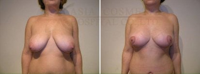 Before and after mommy makeover results at Asia Cosmetic Hospital, breast lift and contouring