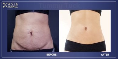 Before and after tummy tuck results at Asia Cosmetic Hospital – flatter, firmer abdomen
