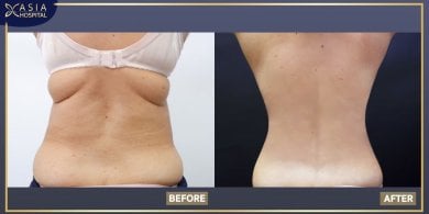 Mommy makeover before and after results at Asia Cosmetic Hospital – visible body contouring