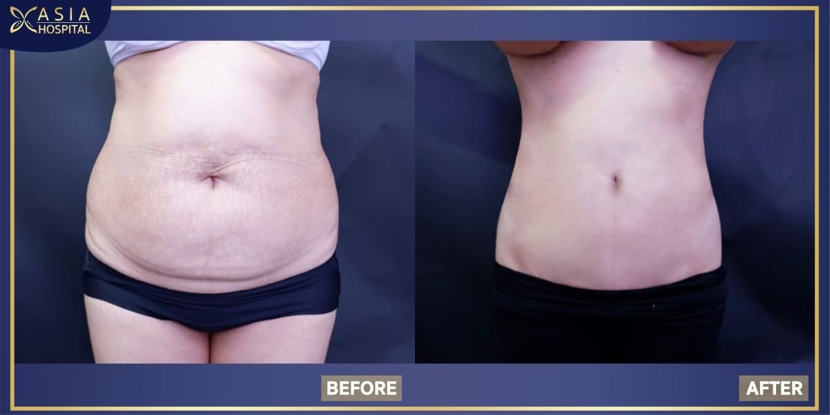 Resultados antes y después de mommy makeover en Asia Cosmetic Hospital – contorno abdominal visible