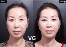 Vorher-nachher-Ergebnis der Jochbeinreduktion bei VG Plastic Surgery, Gesichtskontur