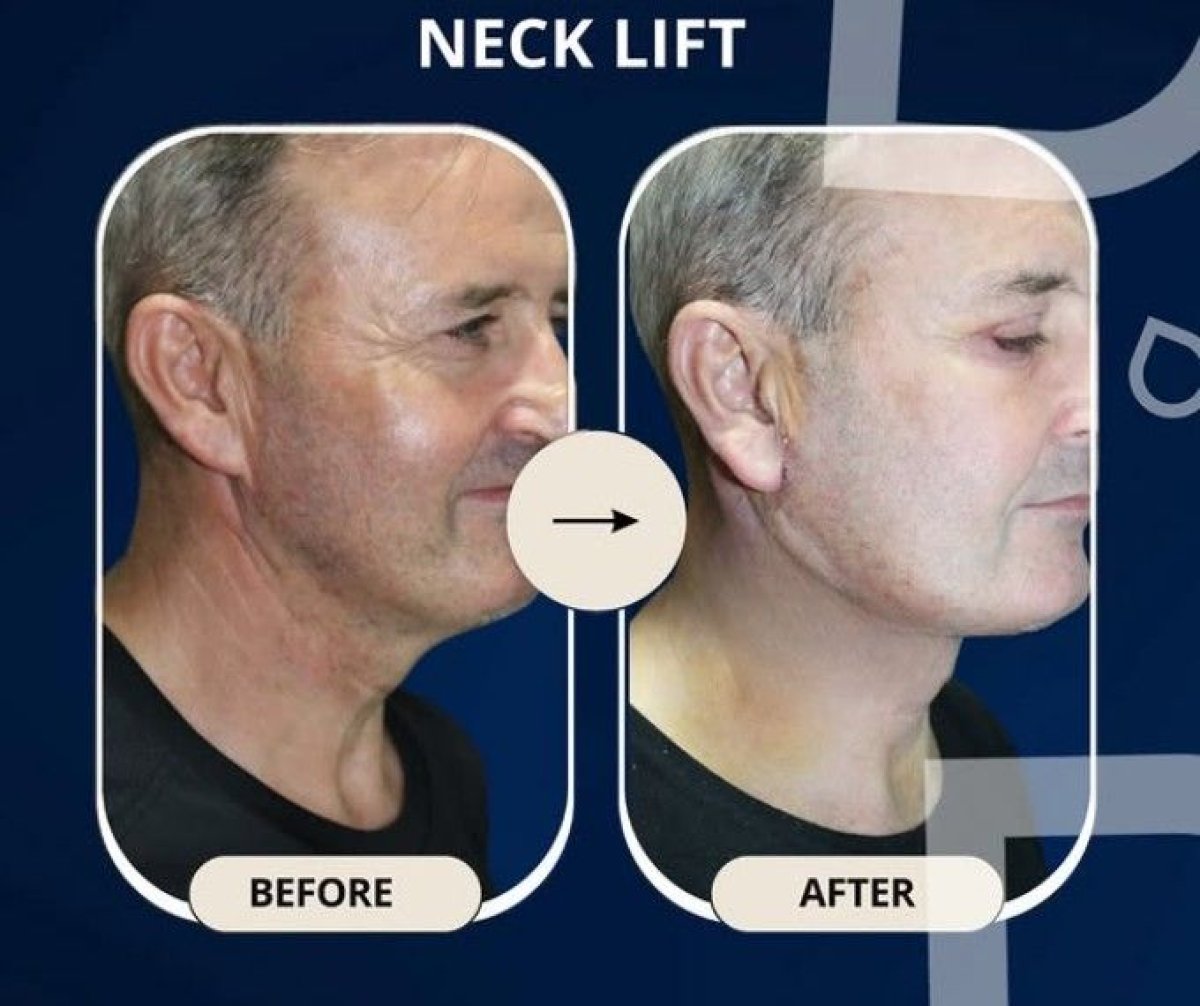 Resultados de lifting de cuello antes y después en TWT Health Clinic, cuello más firme