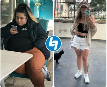 Antes y después de manga gástrica en TWT Health Clinic – resultado visible de pérdida de peso