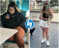 Antes y después de manga gástrica en TWT Health Clinic – resultado visible de pérdida de peso