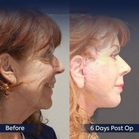 Before and after deep plane facelift result at Dr. Safa Manav Clinic, visible facial rejuvenation