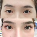 Before and after Fox Eye Lift results at Wansiri Hospital, enhanced eye shape and lift