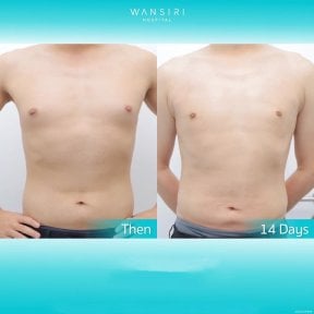 Before and after liposuction for gynecomastia at Wansiri Hospital, chest contour results